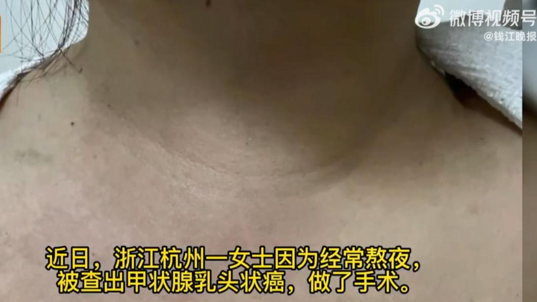 王女聲音沙啞、脖子腫脹，結果檢查後竟罹患癌症。（圖／翻攝自微博）