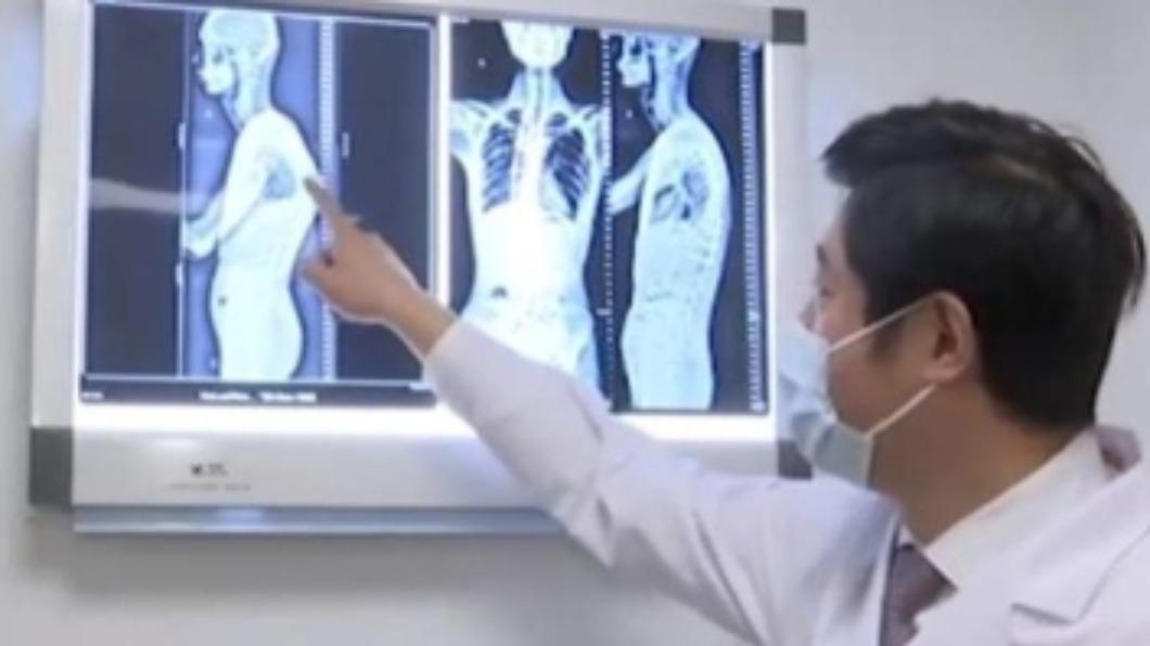 一名年輕男子身高縮水，經查罹患罕病。（圖／翻攝自星視頻）