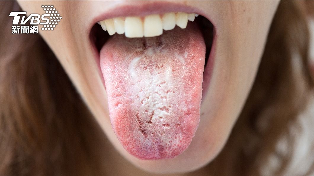 一名女子反覆感冒，舌頭出現異狀。（示意圖／shutterstock達志影像） 