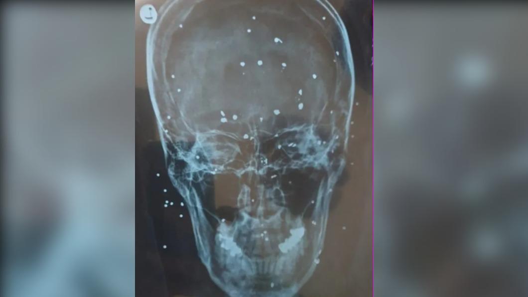 一名傷患的頭骨內滿佈子彈碎片。(圖/翻攝自《衛報》)