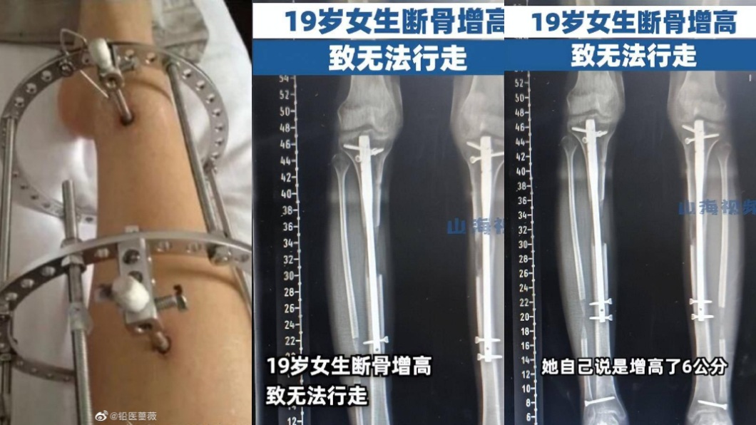 妹子自稱有增高6公分術後卻出現無法行走的情況。(圖/翻攝自微博)
