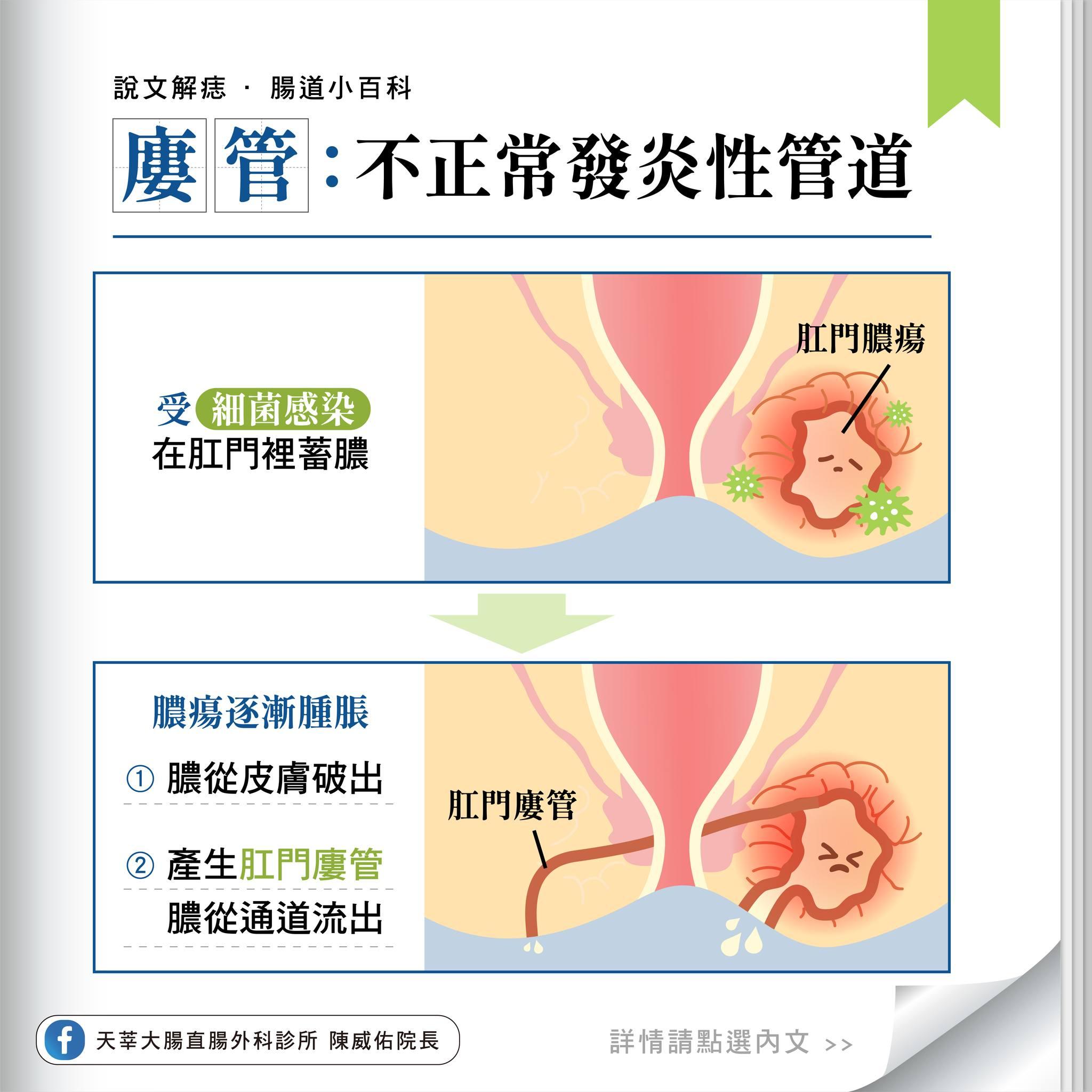 肛門廔管好發於30至50歲男性。(圖/翻攝自陳威佑醫師臉書)