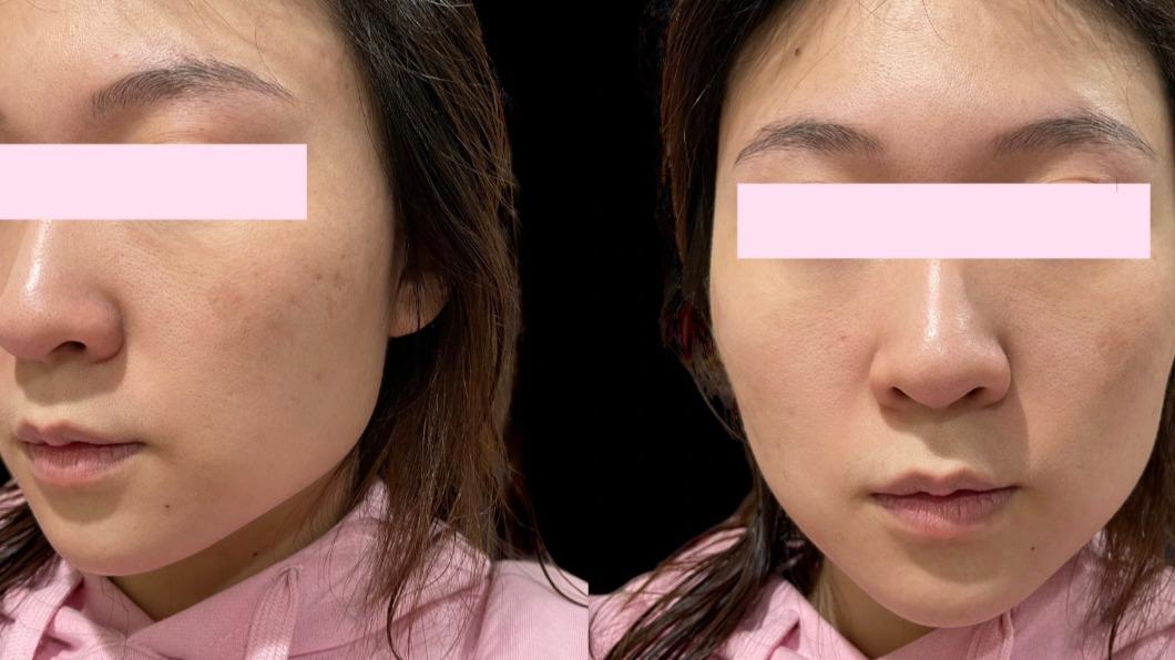 花錢嘸效!愛美女臉冒肝斑打「皮秒」愈打愈黑