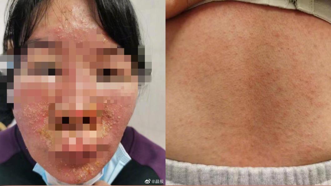 女子發現臉部及身體長滿小農皰嚇得趕緊就醫。(圖/翻攝自晶報微博)