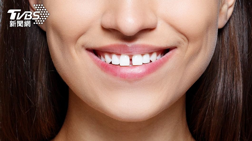 讓牙縫變更大的是牙結石及牙周病。(示意圖/shutterstock達志影像)