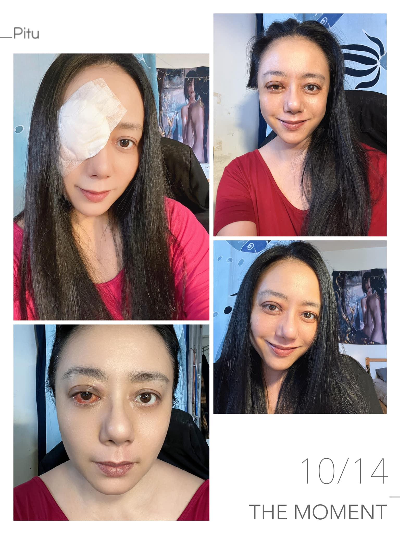 高慧君貼出術後近照。(圖/翻攝自高慧君臉書)