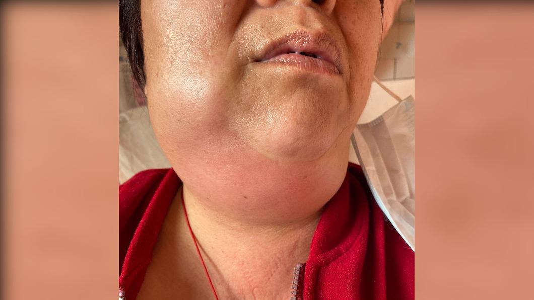 拔牙引發深頸部感染 死亡率高達5成