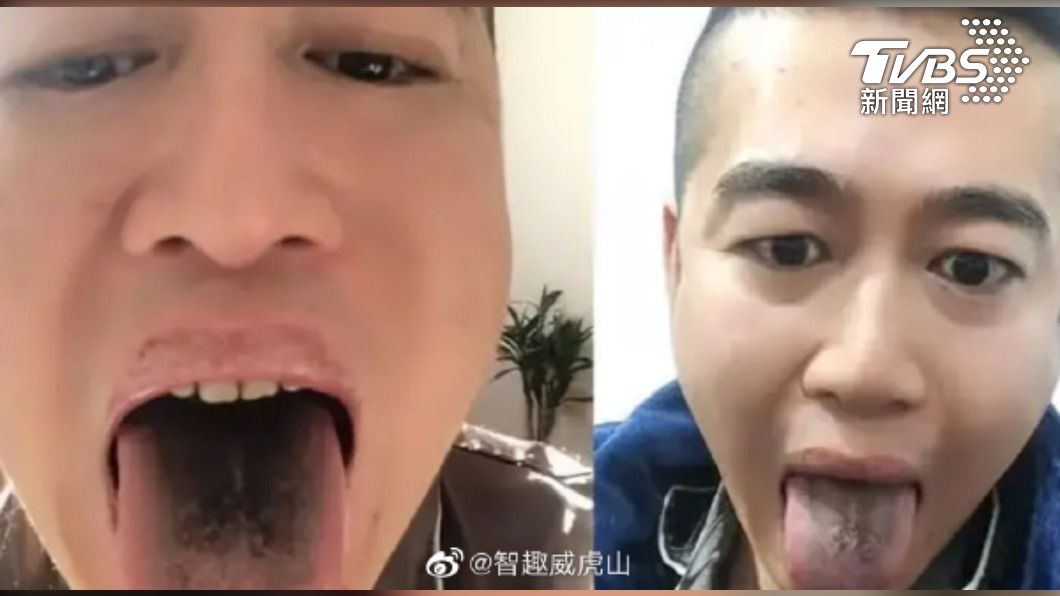 新冠病毒在陸新變種? 網曝眼腫成核桃、牙縫舌苔變黑色