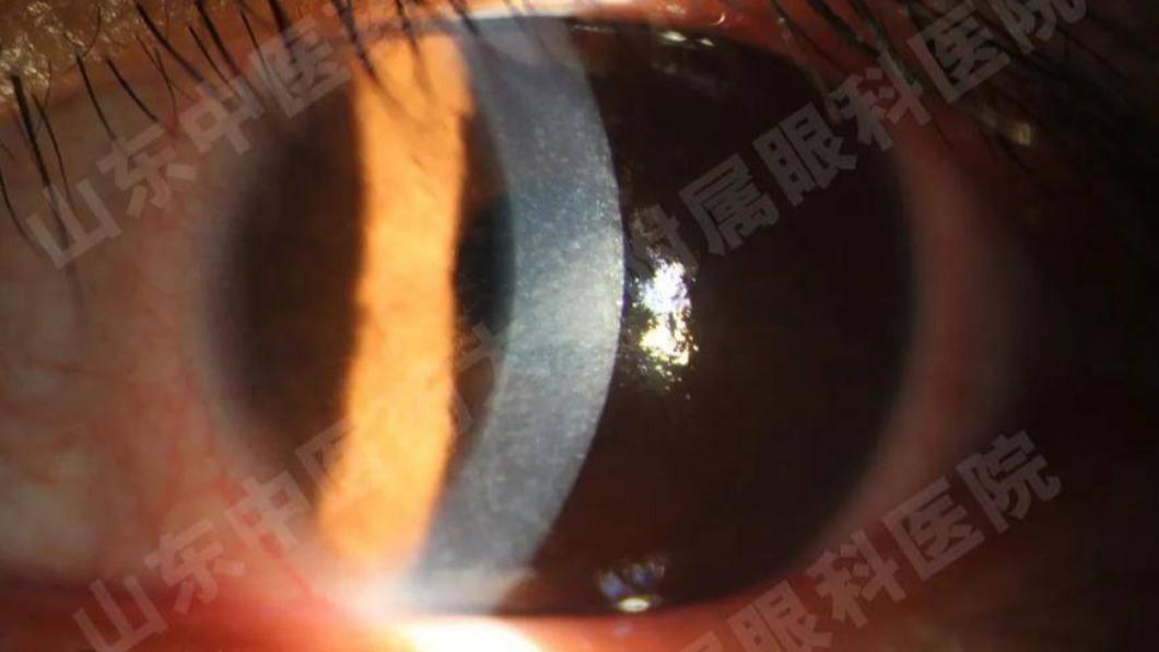 婦女眼角膜已經嚴重受損。(圖/翻攝自微博)