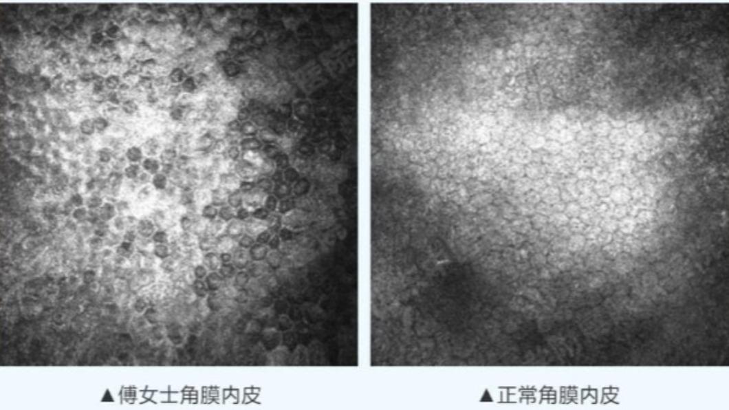 長年配戴隱眼的習慣導致角膜內皮磨損。(圖/翻攝自微博)