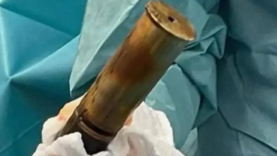 驚！男照X光竟發現直腸塞「一戰未爆彈」　醫院急疏散