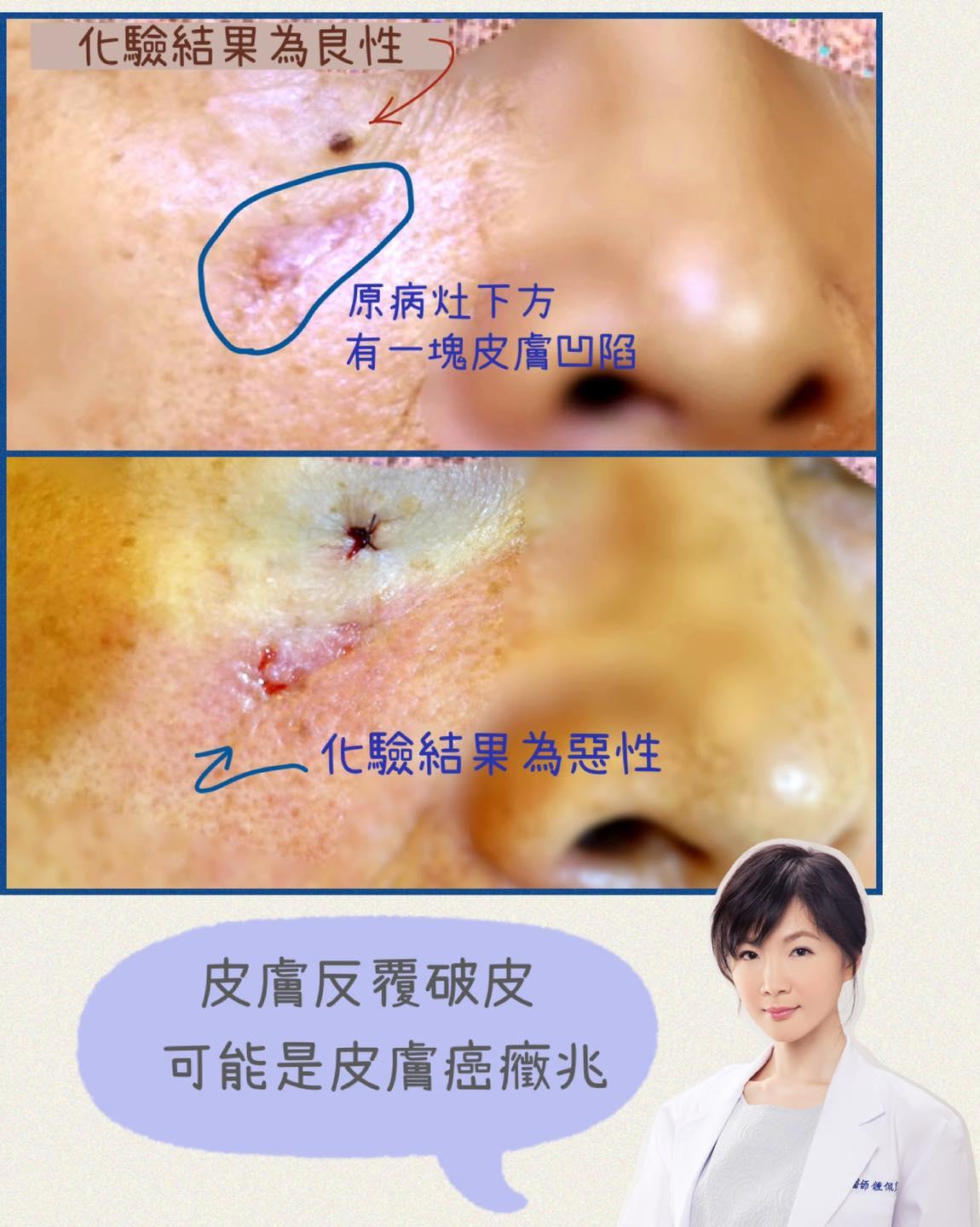 男子皮膚反覆破皮,結果竟檢查出癌症。(圖/翻攝自鍾佩宜醫師臉書)
