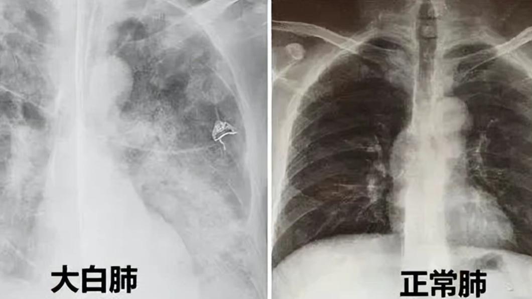 雙肺白化?陸陷新冠「白肺」恐慌 醫闢謠:全世界都有