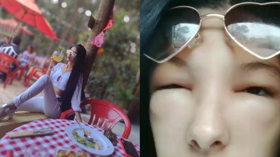 嚴重的過敏反應讓路易莎整張臉都變形。(合成圖/翻攝自IG)