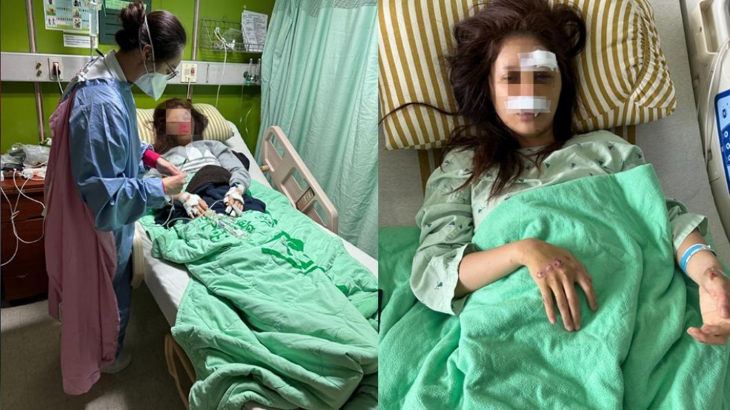 女主播車禍毀容「眼眶斷了」！7小時顏面重建手術　憂1後遺症