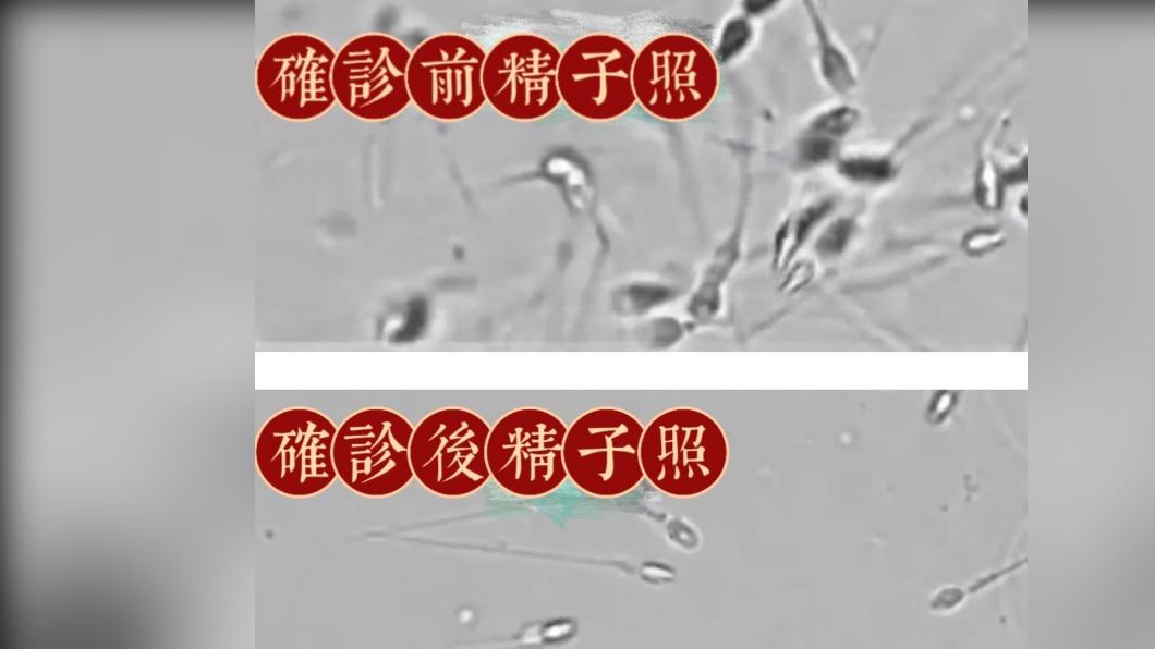 陸醫曝確診前後精子照/圖:微博