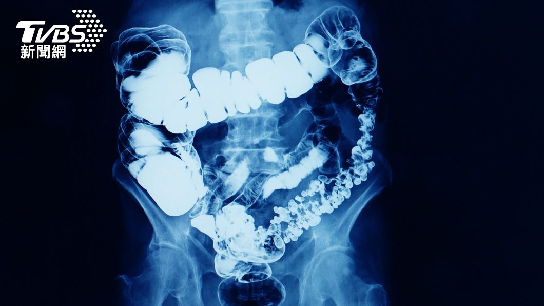 X光一照發現小腸脹到有點像灌香腸。（示意圖，非當事人／shutterstock達志影像）