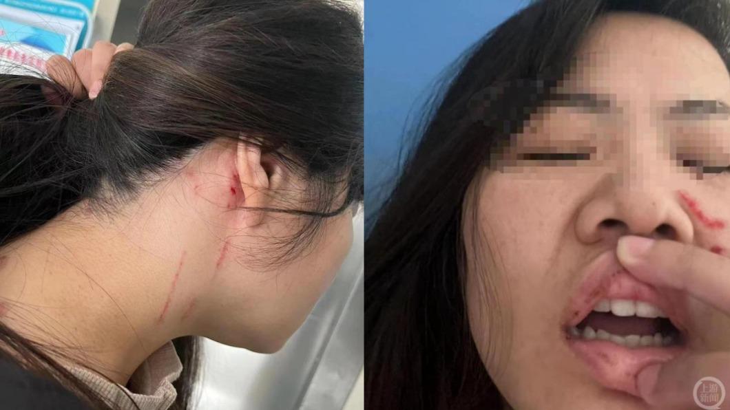 拒絕提親竟被毆打!河南母女雙雙入院 母親慘斷6根肋骨