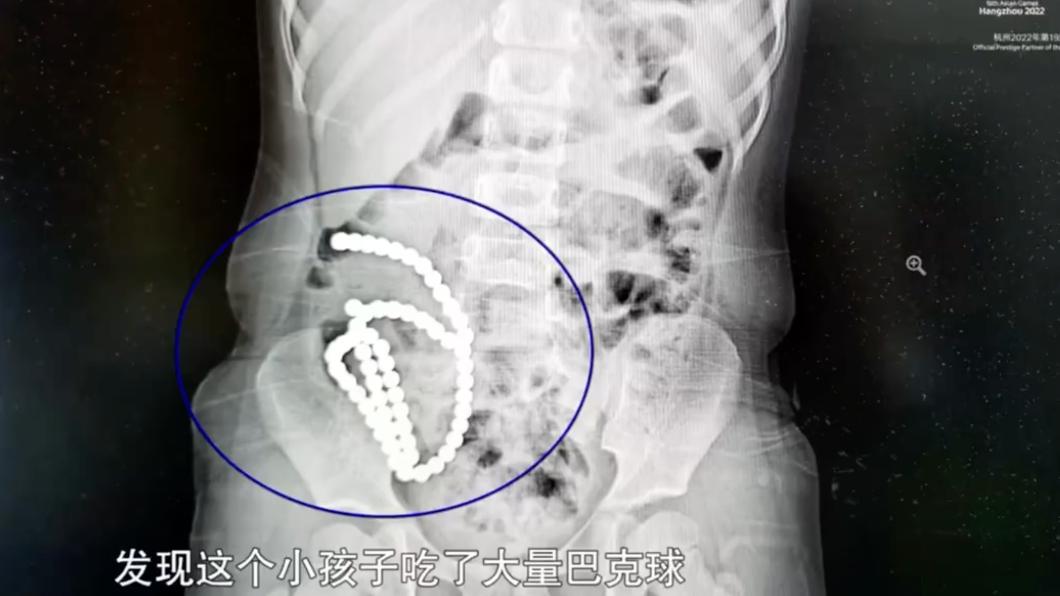 誤吞磁力珠！女童腹中卡「1長串白點」　醫生揭殘忍真相