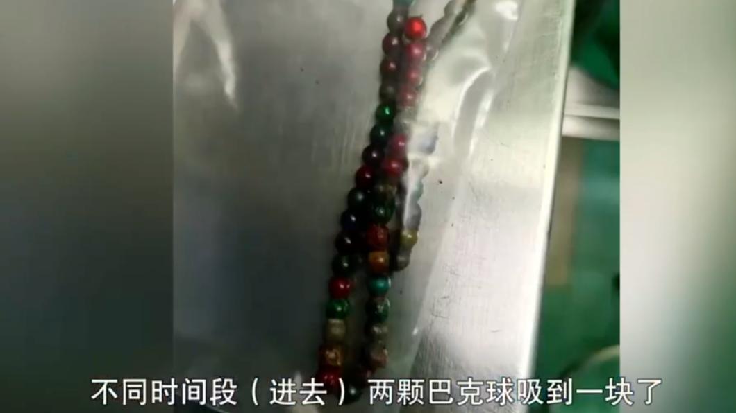 女童體內的61顆巴克球,因彼此吸附造成多處腸穿孔。(圖/翻攝自微博)