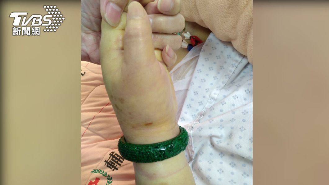 百萬翡翠手鐲卡住！婦手腫兩倍粗　脫戒達人靠這3樣東西解危