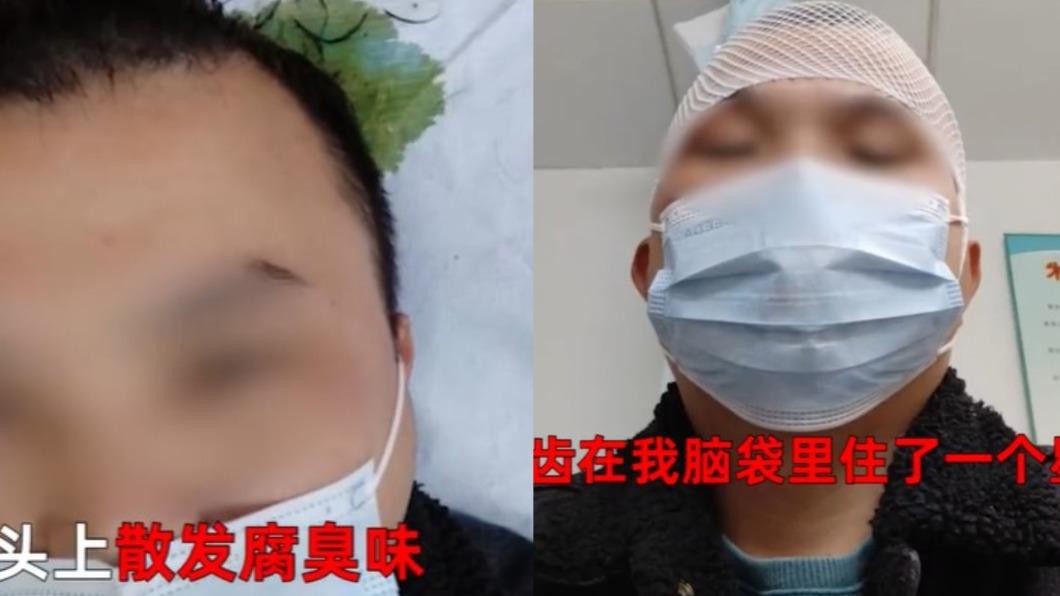 意外發現這兩顆門牙在自己頭頂待了一周之久讓男子相當無言。(圖/翻攝自微博)