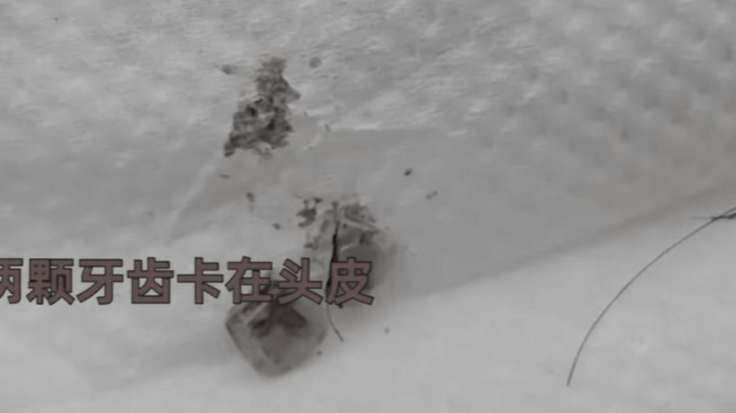打球撞破頭!他濺血一周突聞腐臭 醫傻眼:2顆門牙卡頭皮