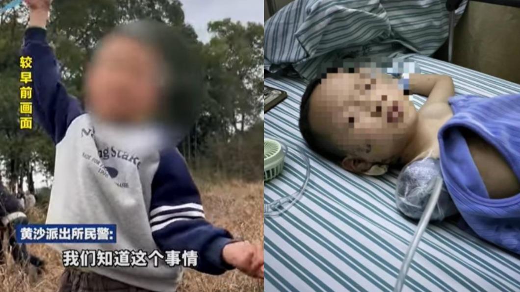 男童耳膜破裂、右臂截肢,對身心靈都造成極大傷害。(圖/翻攝自微博)
