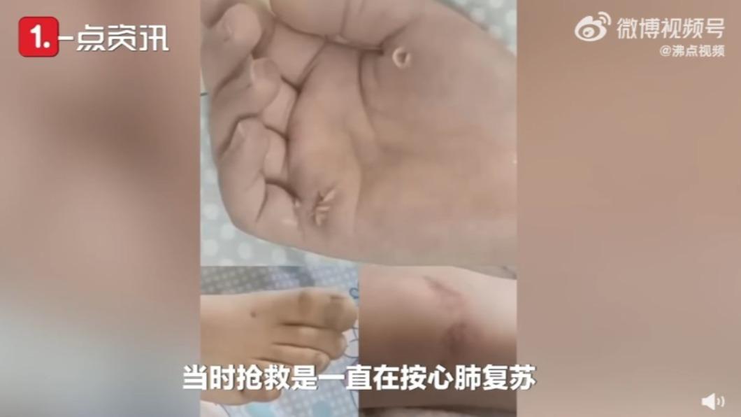 死者傷口。(圖/翻攝自沸點視頻微博)