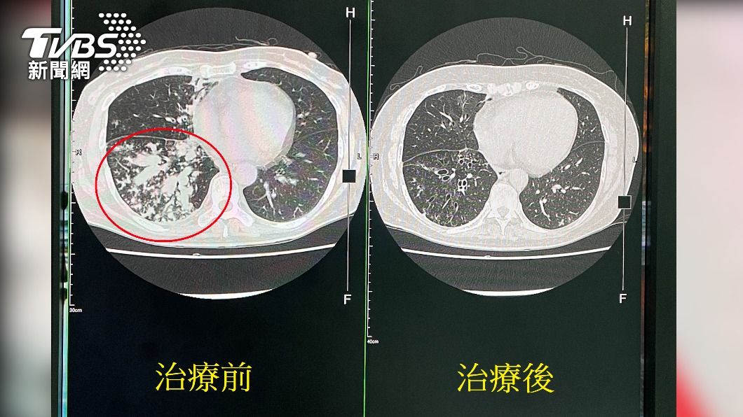 久咳不癒! 她肺部塞滿老痰 醫:像爆漿香腸和串串葡萄