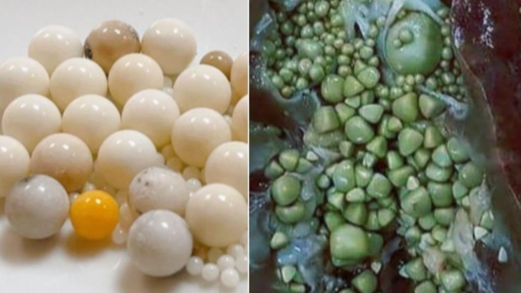 星雲大師舍利子是結石? 醫曬「打臉照」:明明差很多