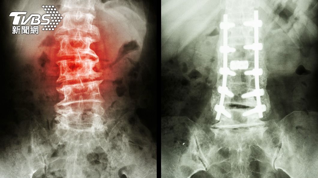 男子被發現腰椎有骨折傷勢。(示意圖/Shutterstock達志影像)