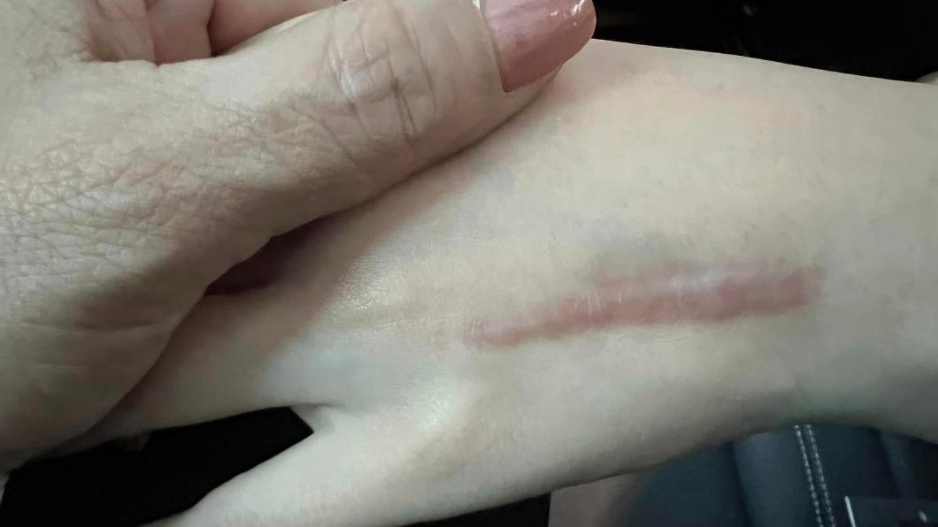 王彩樺女兒左手背傷疤頗長,取出鋼板後還將進行除疤手術。(圖/翻攝自王彩樺臉書)