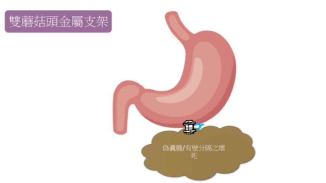 雙蘑菇頭支架。（圖／院方提供）