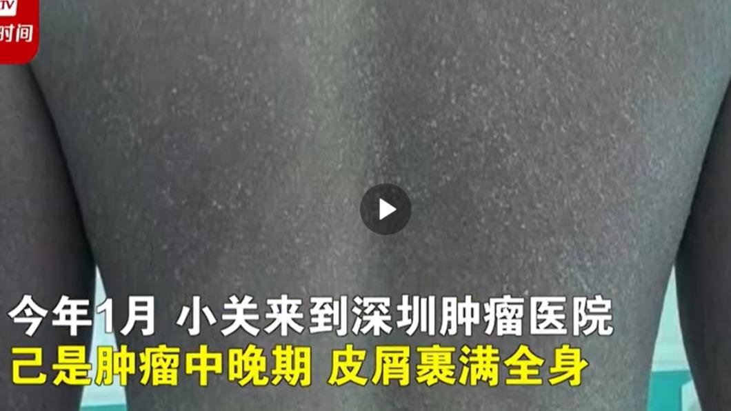 大陸男大生從小學6年級皮膚就出現白色皮屑。(圖/翻攝自微博)