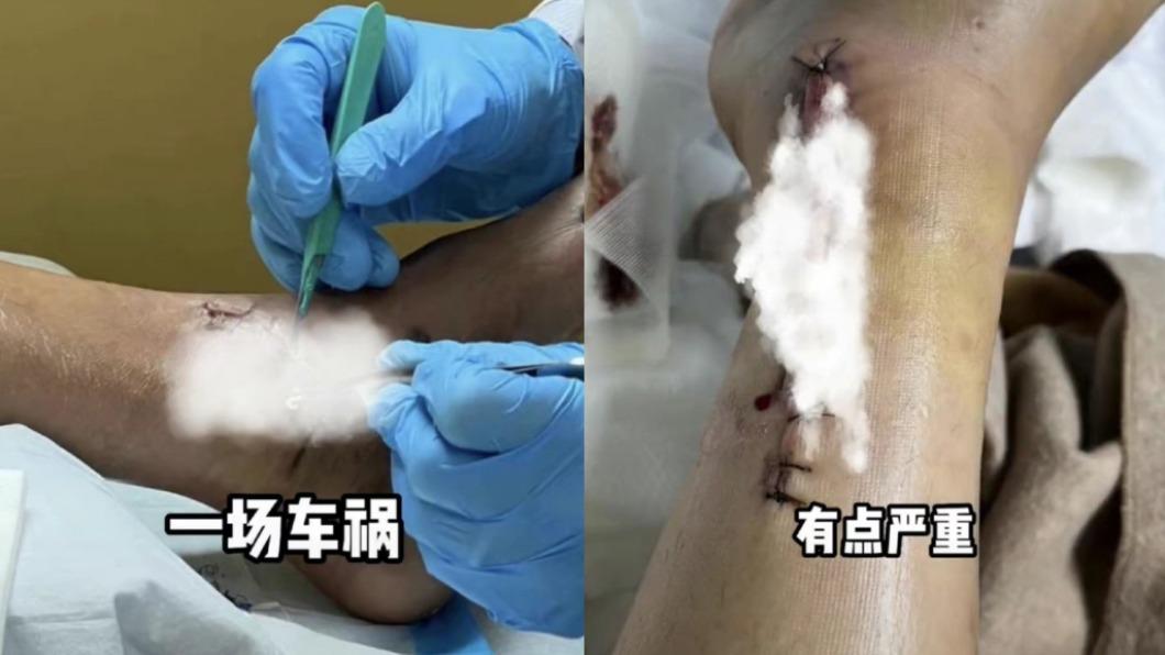 陳學冬左腳傷勢相當嚴重。(圖/翻攝自陳學冬抖音)