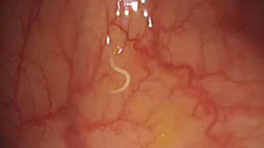 林相宏進行大腸鏡檢查時,發現患者腸內有白蟲在蠕動。(圖/翻攝自「胰臟醫師 林相宏 禾馨民權內科診所」臉書)