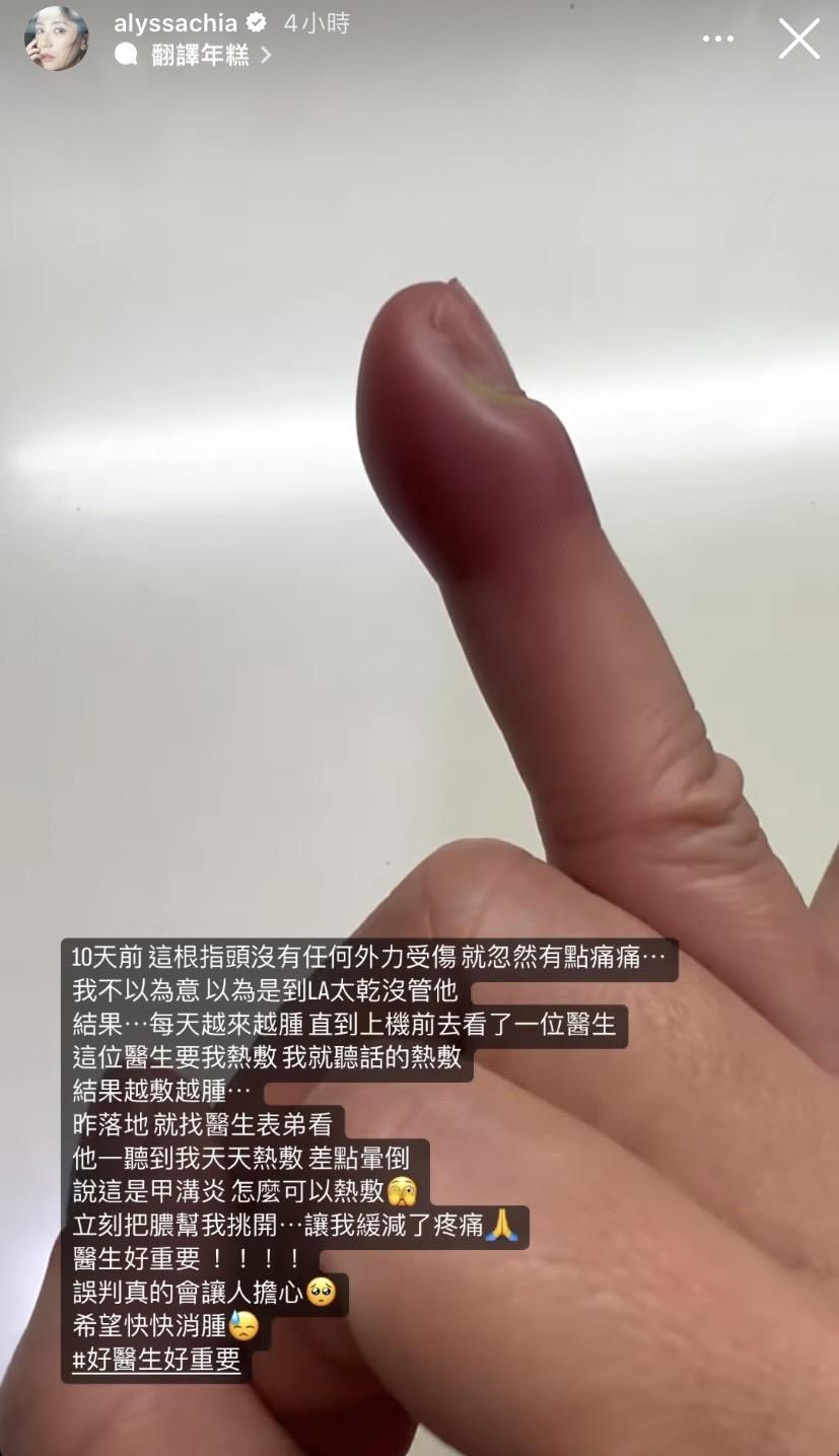 賈靜雯手指腫起來。(圖/翻攝自賈靜雯IG)