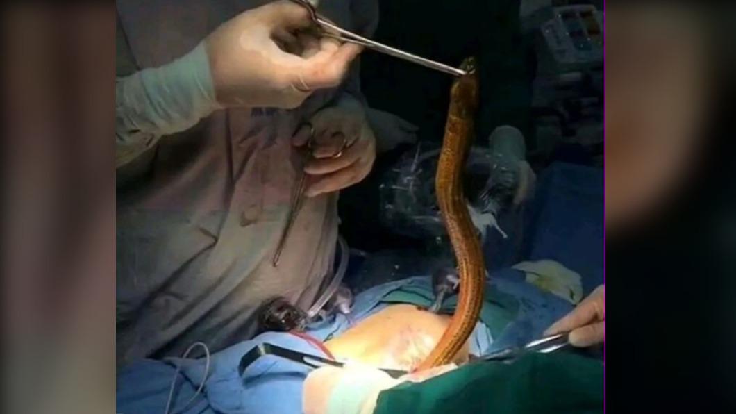 男把「活鰻魚」插入肛門治便祕　牠奮力掙扎逃命穿破腸