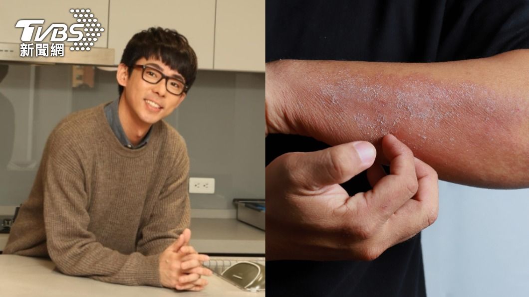 阿滴受皮膚炎所苦!「4禁忌」要避免 醫:別再住漏水屋