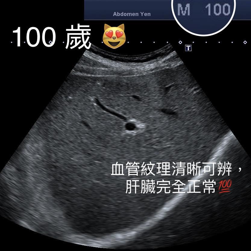 100歲老翁的肝臟十分健康。（圖／錢政弘授權提供）