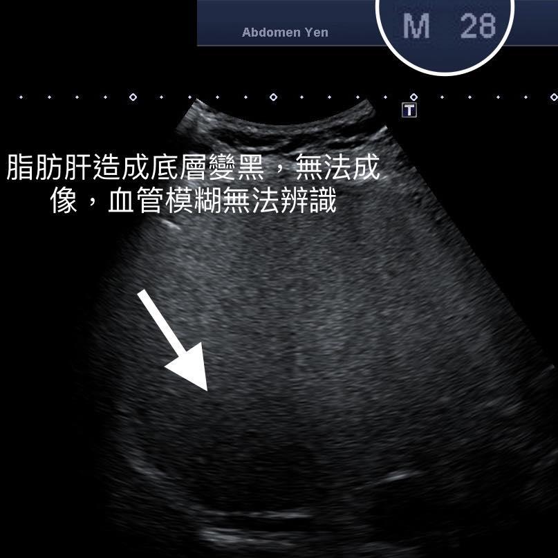 醫師分享28歲年輕人的超音波照，底層因為脂肪肝變黑。（圖／錢政弘授權提供）