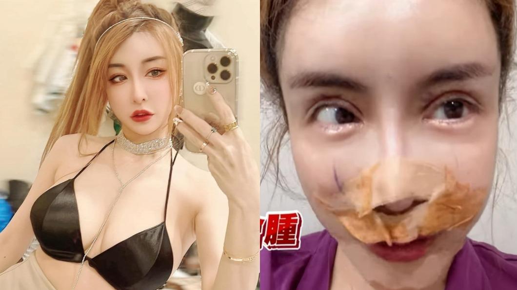 「情色教主」雪碧又整形! 一次做3部位曝血淋淋過程:我有容貌焦慮