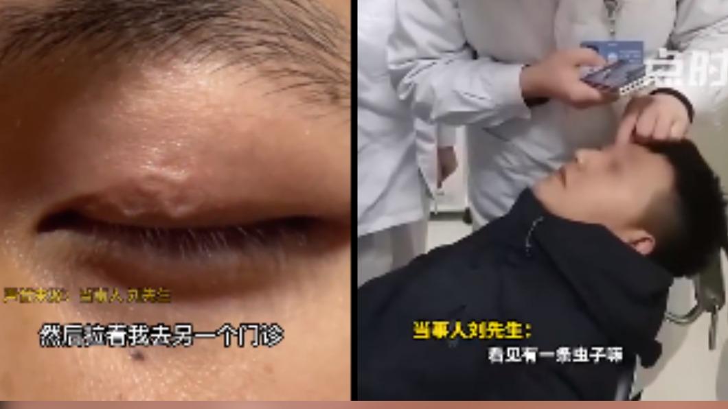 眼皮狂跳！陸男檢查赫見「寄生蟲蠕動」　醫生也大吃一驚