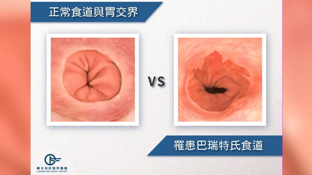 罹患巴瑞特氏食道與正常食道/聯安預防醫學機構