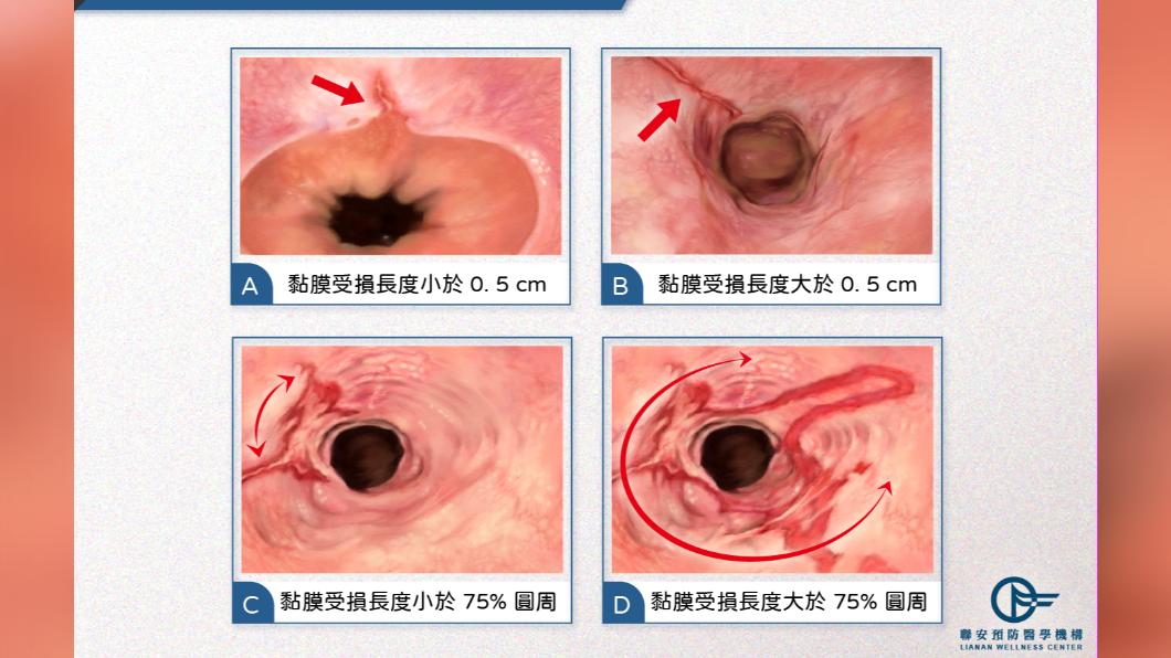胃食道逆流嚴重程度/聯安預防醫學機構提供