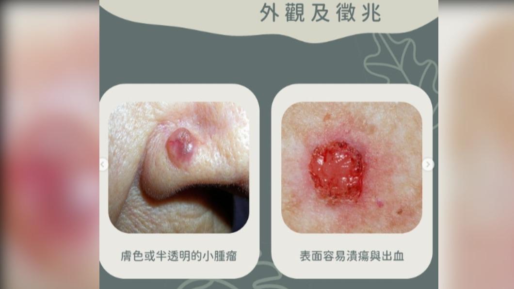 基底細胞癌外觀是膚色或半透明小腫瘤,表面易出現潰瘍與出血。(圖/翻攝自黃晨昊IG)