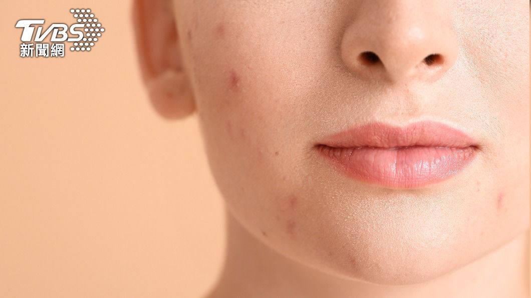 發炎的痘痘可分為丘疹、膿皰和囊腫型。(示意圖/shutterstock達志影像)