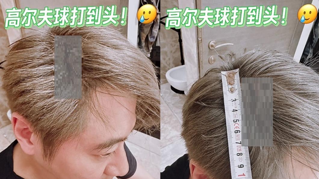 孫耀威不慎被高爾夫球砸頭。(圖/翻攝自孫耀威小紅書)