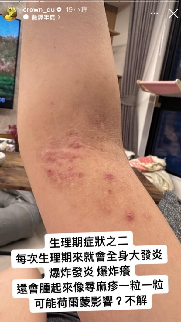 滴妹的手被她抓到泛紅。(圖/翻攝自滴妹IG)